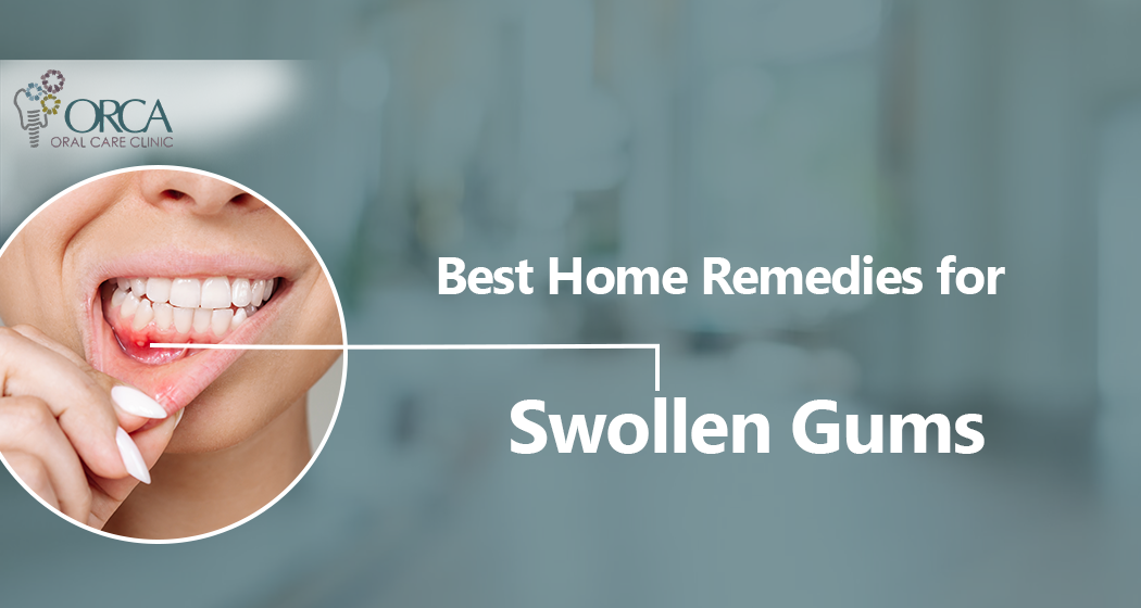 Best Home Remedies for Swollen Gums Orca Oral Care Clinic